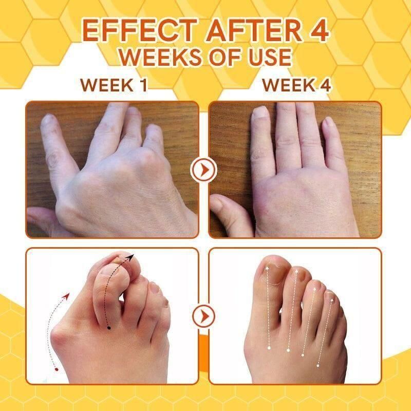 Bee Venom Spider Veins Spray Pack of 2 cs2856-ri