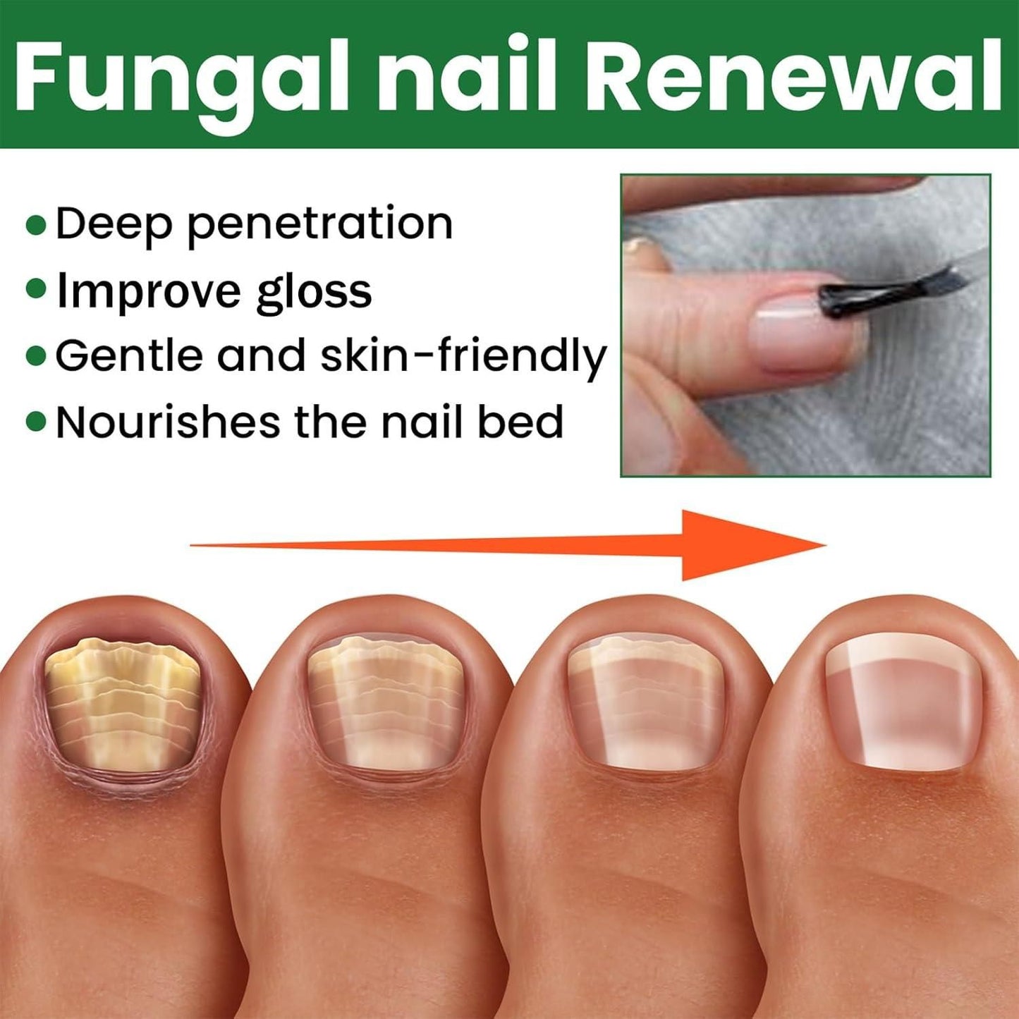 Fungal Nail Renewal