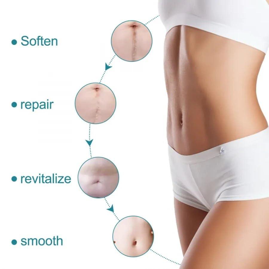 Silicone Scar Sheets