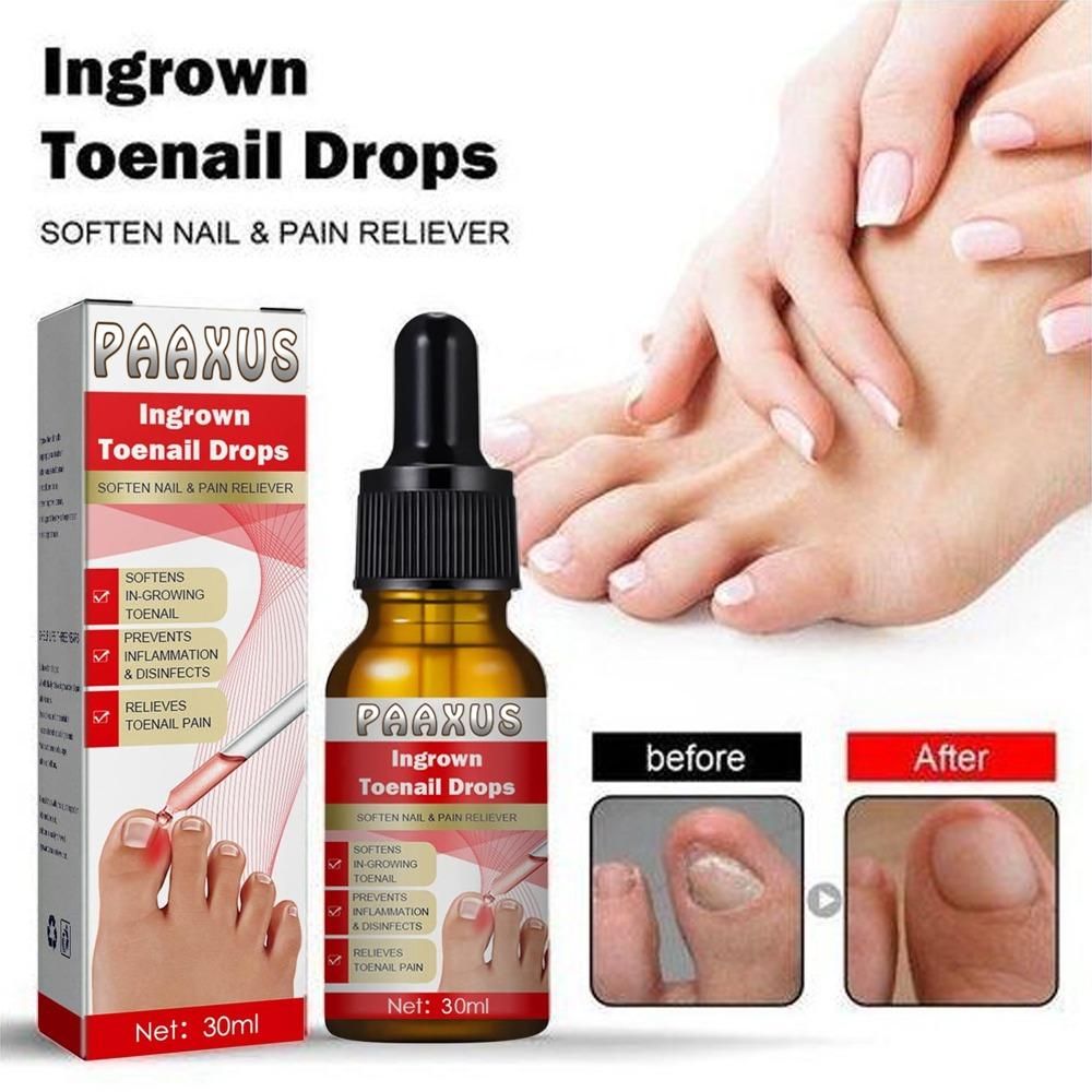 Ingrown Toenail Drops 60 ml Pack of 2 cs2856-ri