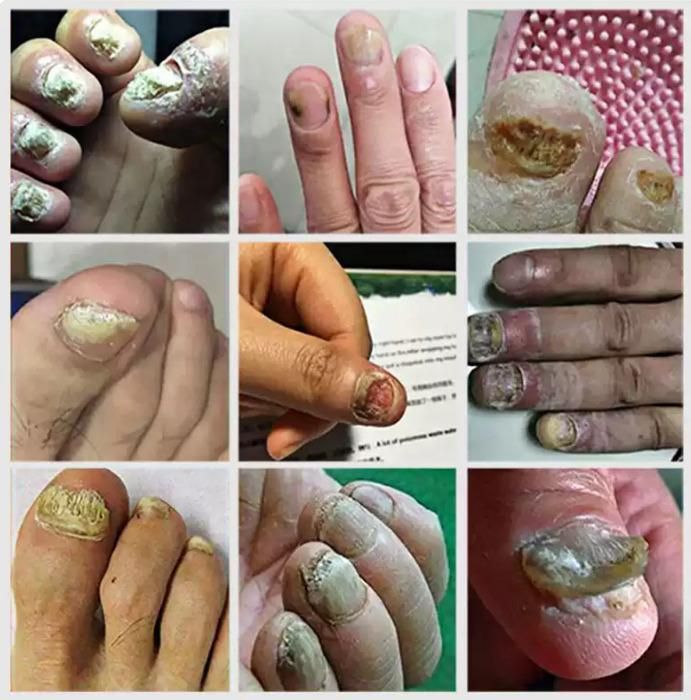 Ingrown Toenail Drops 60 ml Pack of 2 cs2856-ri